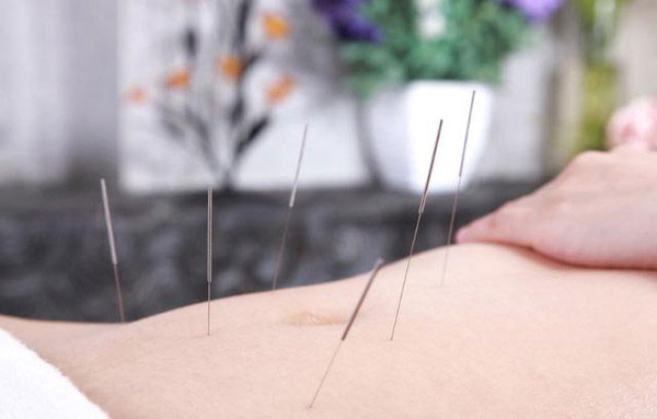 鍼治療用のハリ