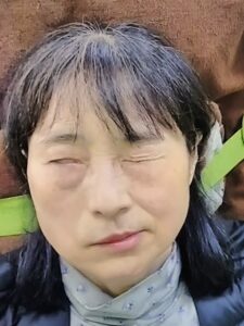 重症ハント麻痺 軽く閉眼