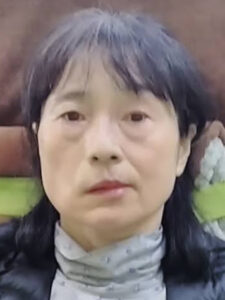 重症ハント麻痺