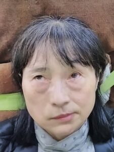 ハント麻痺 おでこにしわ寄せ
